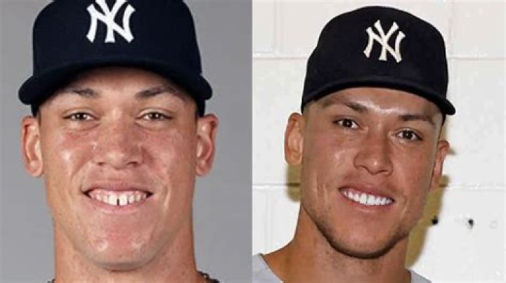 Aaron Judge's Teeth Before And After 