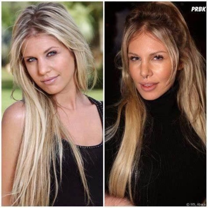 Adixia Avant Chirurgie