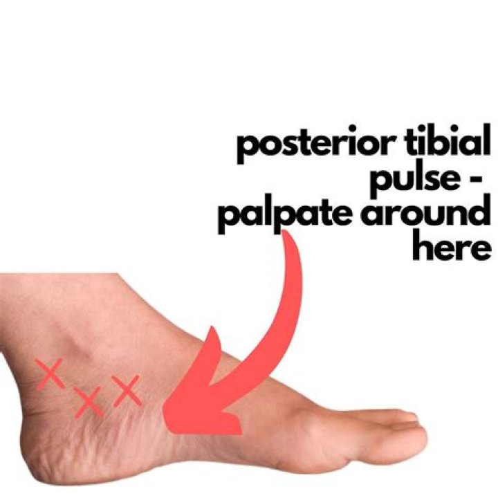 	ANKLE PULSE OFFERS CLUES	