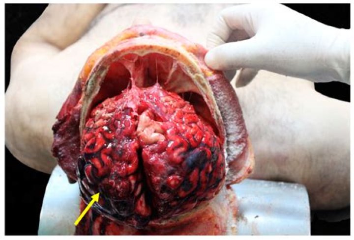 	AUTOPSY REVEALS BRUTAL BEATING	