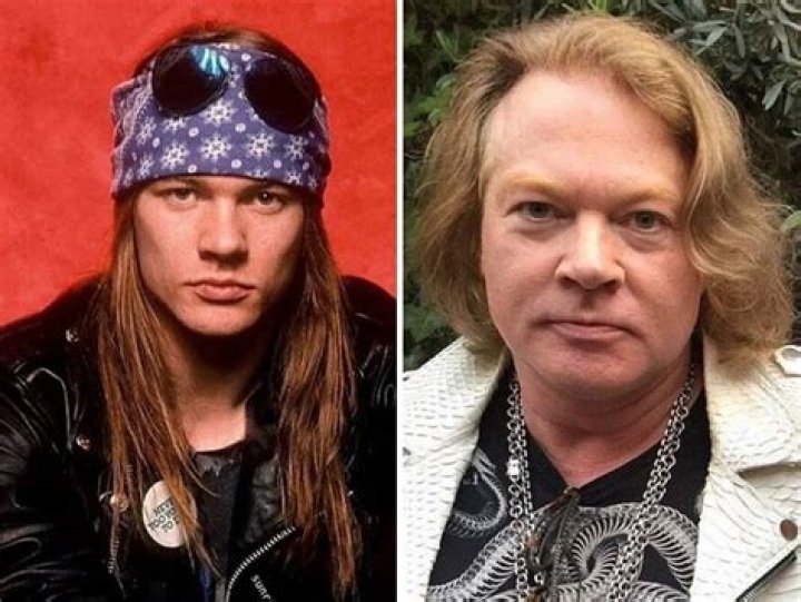 Axl Rose Plastic Surgery: Unveiling The Truth Behind The Rock Legend's Transformation