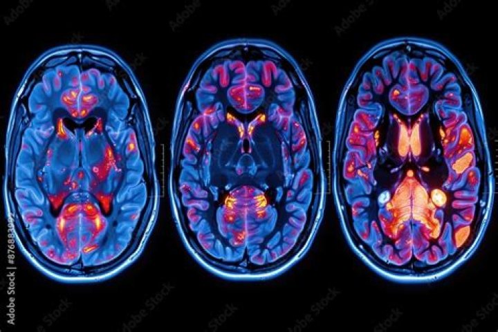 	BRAIN MRIS CHANGE AS WE AGE	