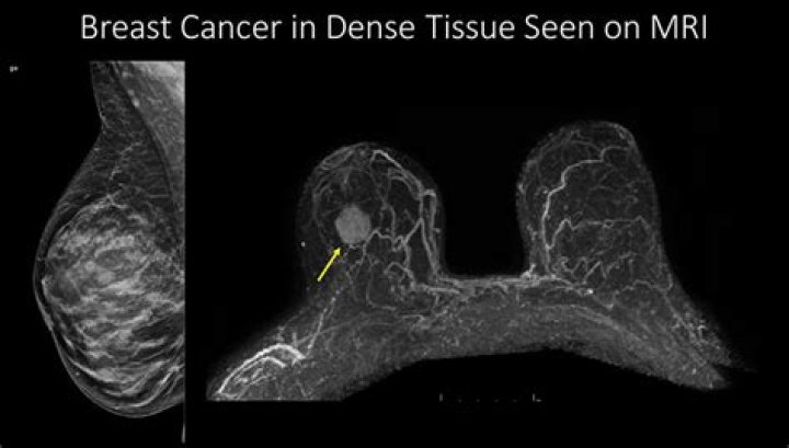 	Cancer in dense breasts spurs a movement	