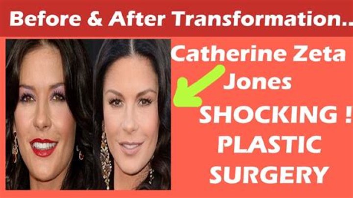 Catherine Zeta Jones Chirurgie