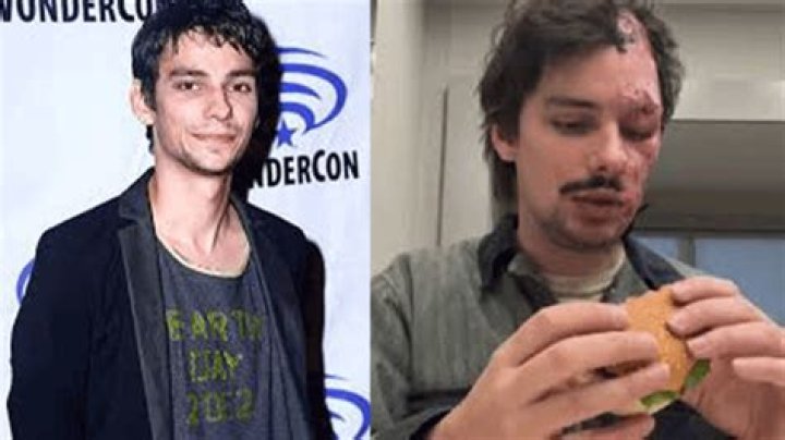 Devon Bostick Accident, Face injury, Burn rumor: What Happened?