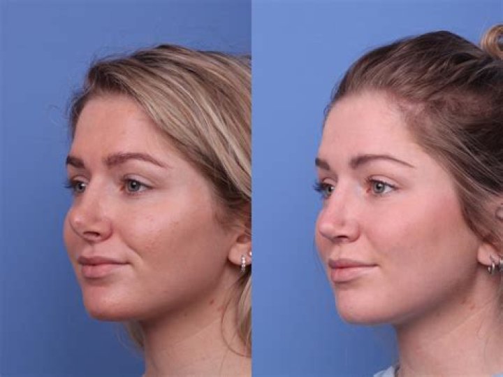 Dixie D'Amelio explains why she waited to get nose surgery
