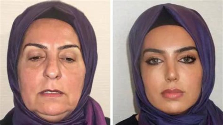 Exploring Tyla Surgery: The Journey Of Transformation