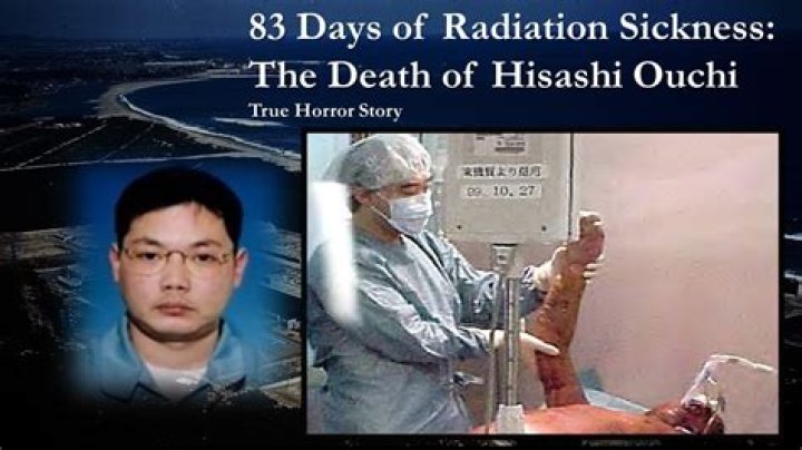 Hisashi Ouchi: The Tragic Story Of A Nuclear Accident Survivor