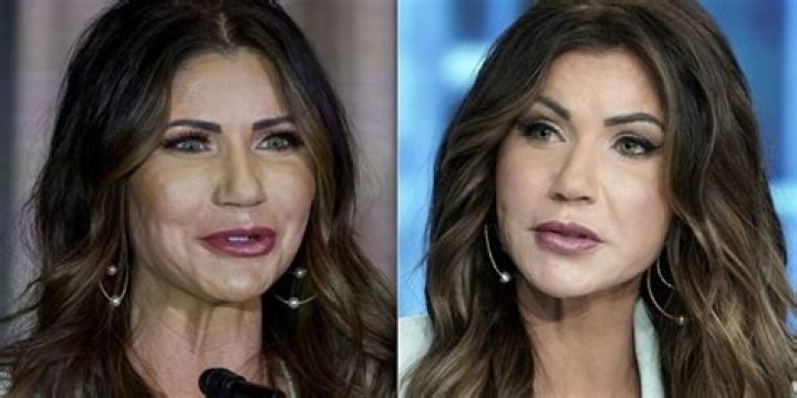 Kristi Noem Before And After Cosmetic Surgery: A Comprehensive Analysis