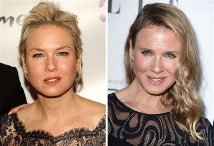 Renee Zellweger Surgery: Unveiling The Truth Behind The Transformation