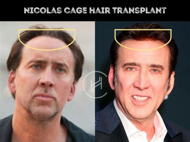 Truth About Nicolas Cage’s Hair Transplant And Hair Loss