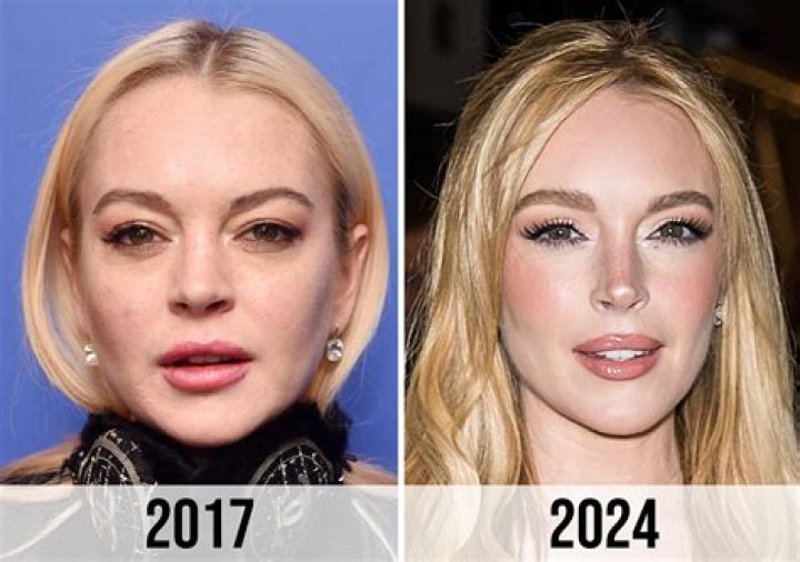 Unveiling Lindsay Lohan's Plastic Surgery Journey: Discoveries And Insights