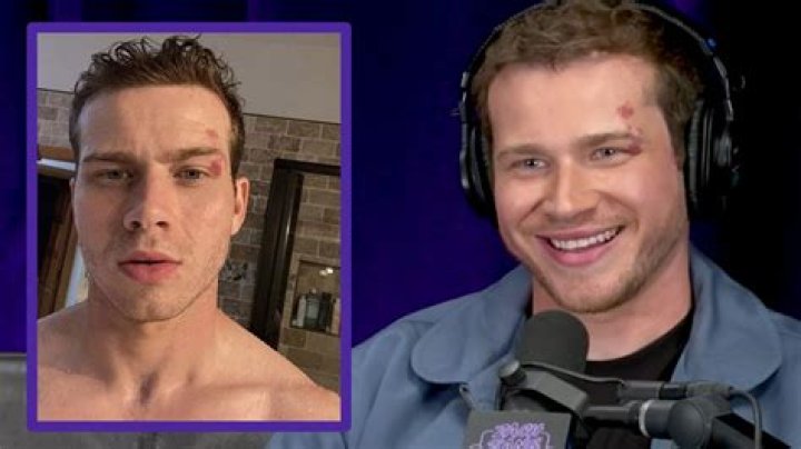 Unveiling The Enigma: Oliver Stark's Birthmark And Its Untold Story