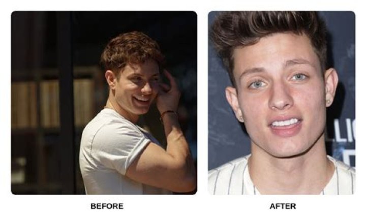 Unveiling The Truth Behind Matt Rife's Dental Surgery