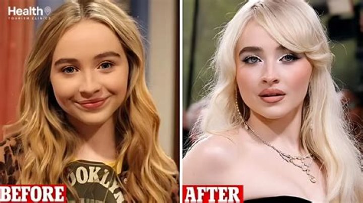 Unveiling The Truth: Did Sabrina Carpenter Undergo Surgery?