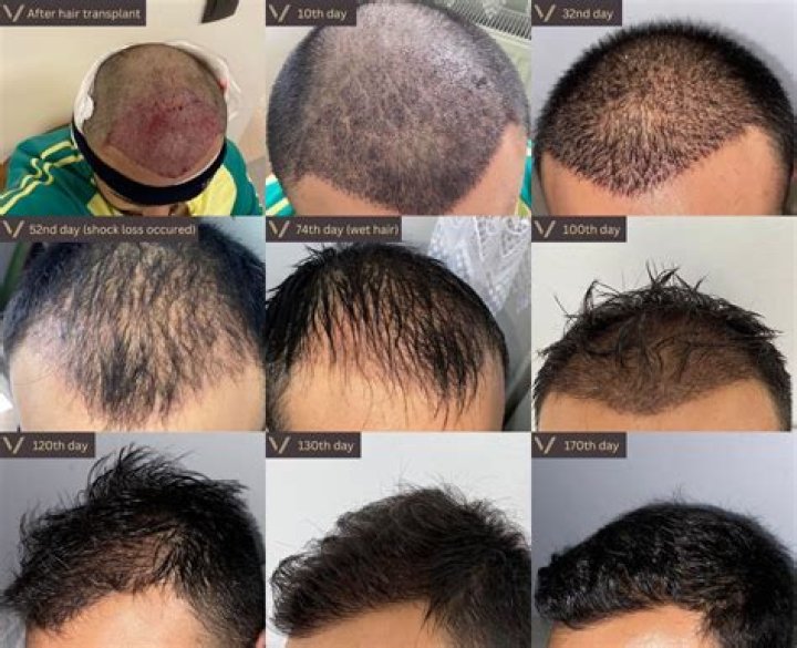 	Unwanted hair and tattoos driving growth at Boca company	