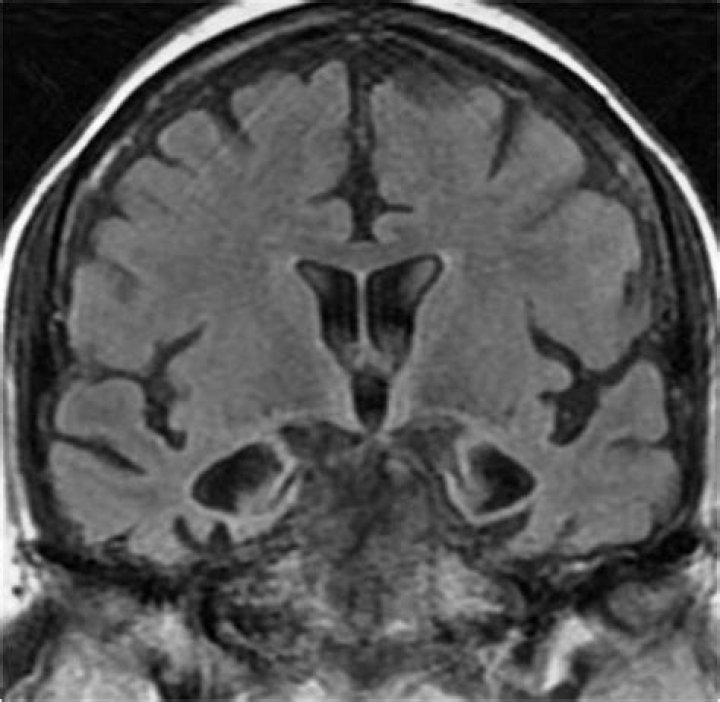 Visual perception problems | Alzheimer's Society