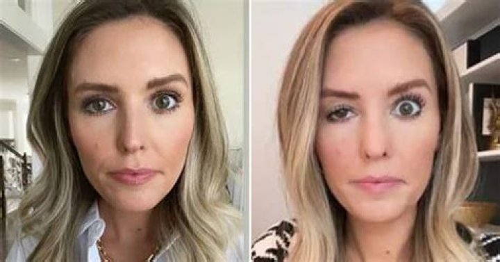 What’s Wrong With Her Lips? Is It Botched Surgery?
