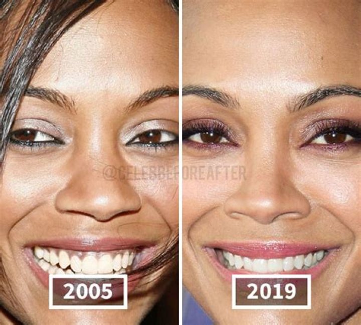 Zoe Saldana's Plastic Surgery: Unveiling The Truth